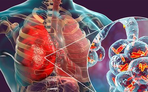 Cảnh báo nguy cơ mắc ung thư phổi gia tăng ở nhóm không hút thuốc