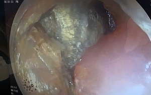 Cảnh báo nguy cơ từ pin cúc áo: Bé trai 2 tuổi suýt thủng thực quản