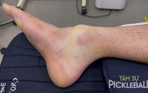 Choáng với hình ảnh cổ chân một thanh niên sau 4 giờ chơi pickleball liên tục