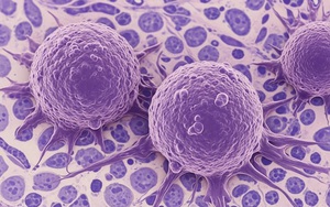 Xét nghiệm máu siêu nhạy của Johns Hopkins phát hiện ADN ung thư sớm 3 năm