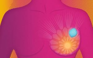 AstraZeneca công bố đột phá của thuốc điều trị ung thư vú