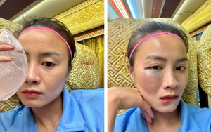 Hot girl của ĐT nữ Việt Nam 'khoe' khuôn mặt bầm tím vì chấn thương sau trận ra quân ở giải VĐQG 
