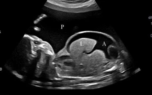 Truyền máu cho thai nhi qua dây rốn: Can thiệp kịp thời – Giữ trọn cơ hội sống cho thai nhi thiếu máu