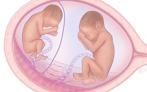 Can thiệp bào thai bằng kỹ thuật nội soi buồng ối đốt dây rốn bằng laser: Kỹ thuật tiên tiến chỉ định trong trường hợp nào?