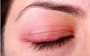Viêm bờ mi - bệnh lý thường gặp, dễ tái phát