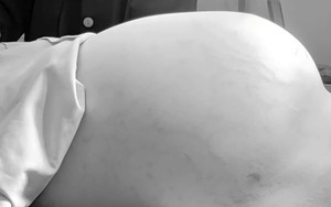 Phẫu thuật thành công khối bướu buồng trứng nặng 15 kg ở bé gái 14 tuổi