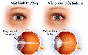 Mắt mờ ở người lớn tuổi - đừng vội nghĩ chỉ do tuổi tác