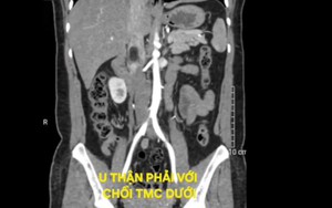 Lấy trọn khối u thận hiếm gặp qua phẫu thuật nội soi