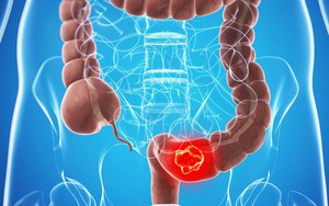 Yếu tố làm tăng nguy cơ mắc ung thư đại trực tràng