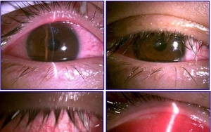 Tìm hiểu về bệnh đau mắt đỏ