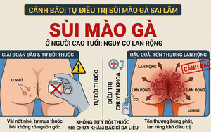 Sùi mào gà ở người cao tuổi: Xấu hổ tự điều trị hay đối mặt nguy cơ lan rộng khó lường?