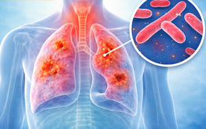 Phát hiện lao gắn với khám sức khỏe định kỳ cho mỗi người dân