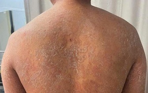 Suýt mất làn da khi tự chữa nấm bằng kem bôi không rõ nguồn gốc