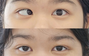 Lác (lé) mắt - có thể điều trị được không?