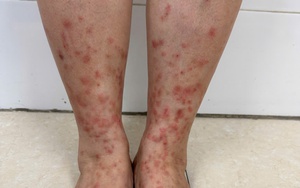 Viêm da do bọ chét gia tăng, cẩn thận sai lầm khi tự điều trị