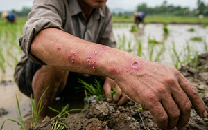 Cảnh báo nguy cơ bệnh Whitmore bùng phát sau mưa lũ