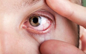 Thoái hóa giác mạc - tác động môi trường đến "cửa sổ tâm hồn"