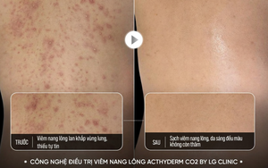 Cơ chế đột phá nào giúp Acthyderm – CO2 xóa sổ cả viêm nang lông, mụn lưng & thâm sần trong 1 liệu trình?
