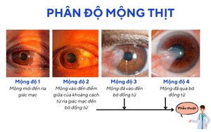 Mộng thịt khi nào cần phẫu thuật?