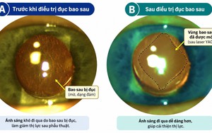 Đục bao sau: nguyên nhân giảm thị lực thường gặp sau mổ đục thể thủy tinh