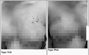 Ngực biến dạng, áp xe nặng sau khi tiêm filler tại nhà 