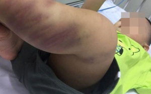 Phẫn nộ kẻ bạo hành bé trai hơn 1 tuổi đến tổn thương não ở Hà Nội