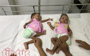 Căng thẳng ca phẫu thuật tách rời cặp song sinh hiếm gặp