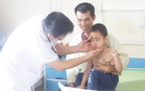 Bé 5 tuổi mọc rậm lông mặt sau 4 ngày tiêm thuốc Corticoid không đúng chỉ định