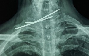 Cứu sống bệnh nhân bị đinh đâm xuyên thực quản và khí quản