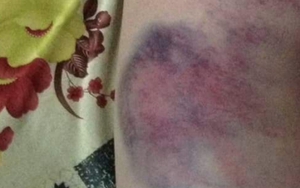 Đã xác minh làm rõ vụ giáo viên đánh học sinh bầm tím ở Đắk Lắk