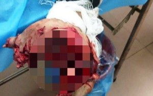 Điện thoại nổ khi đang sạc, nam thanh niên bị nát bàn tay