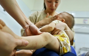 Các cơ sở y tế sẵn sàng tiếp nhận và điều trị bệnh tay chân miệng