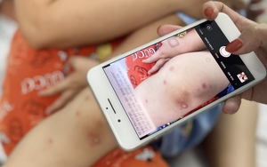 Không để dịch bệnh tay chân miệng bùng phát, lan rộng và kéo dài