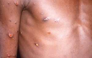 WHO: Không có bằng chứng cho thấy virus đậu mùa khỉ đã biến đổi