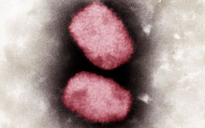 Bộ Y tế hướng dẫn các biện pháp phòng, chống tạm thời với bệnh đậu mùa khỉ