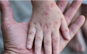 Thế giới cần tăng cường năng lực trước sự lây lan của bệnh đậu mùa khỉ