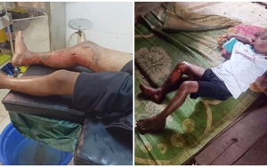 Tạm giữ hình sự một đối tượng trong vụ việc cháu bé 8 tuổi bị bỏng xăng