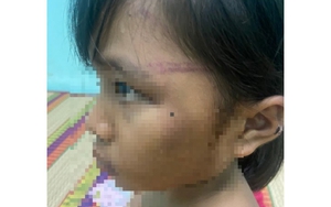 Xác minh vụ việc một bé gái 7 tuổi nghi bị bạo hành ở Bình Phước