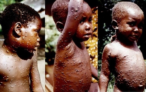 WHO cảnh báo nguy cơ gia tăng số ca tử vong tại châu Âu vì bệnh đậu mùa khỉ