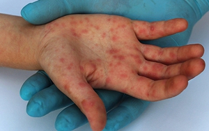 Đức ghi nhận ca mắc đậu mùa khỉ đầu tiên ở trẻ em