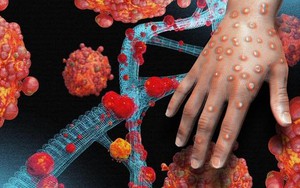 Bộ Y tế thông tin về bệnh nhân đầu tiên mắc bệnh Đậu mùa khỉ tại Việt Nam