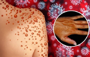 Khuyến cáo phòng, chống bệnh đậu mùa khỉ