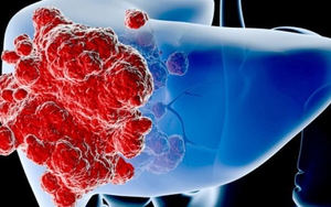 Cảnh báo số ca tử vong trên thế giới do ung thư gan sẽ tăng mạnh