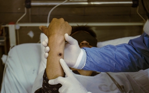 Bệnh nhân đậu mùa khỉ có thể truyền virus trước khi xuất hiện triệu chứng bệnh