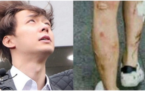 Rùng mình nhìn những vết loét, sưng rộp trên chân tay của Park Yoo Chun, hậu quả của nghiện ma túy đá