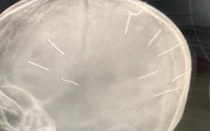 Cục Trẻ em đề nghị nhanh chóng điều tra, làm rõ vụ bé gái có 9 đinh ghim trong đầu