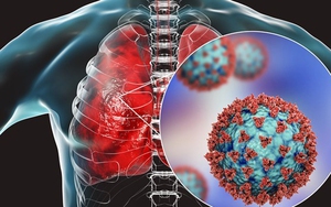 Phổi có thể tiếp tục tổn thương rất lâu sau khi mắc Covid-19