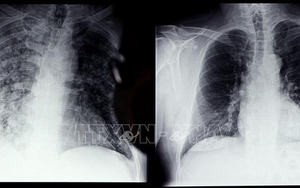 Tác động của Covid-19 đối với chức năng phổi của người trẻ