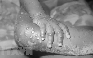 Bệnh đậu mùa khỉ: Pháp thông báo chiến lược tiêm chủng, Mỹ ban hành cảnh báo mới