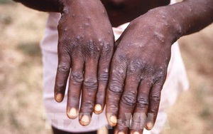 Chuyên gia y tế trấn an về bệnh đậu mùa khỉ